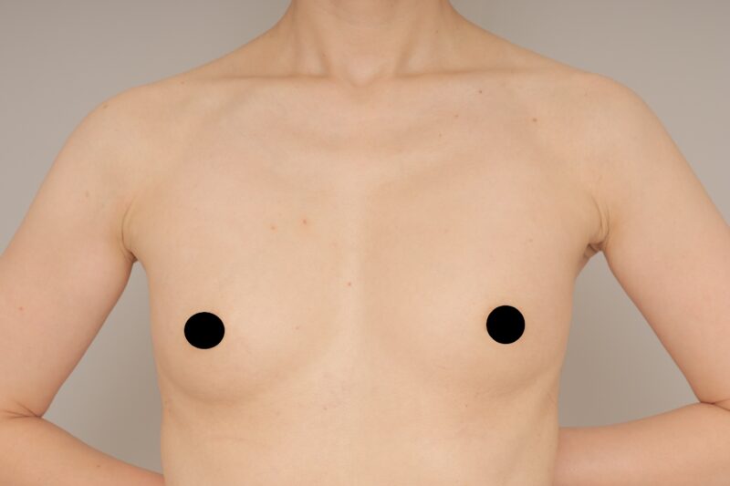 ベイザー脂肪吸引（1ヵ月経過：46）の術前写真