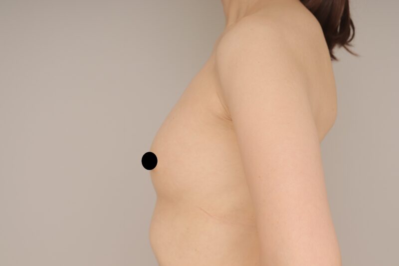 ベイザー脂肪吸引(3か月経過:46)の術前写真