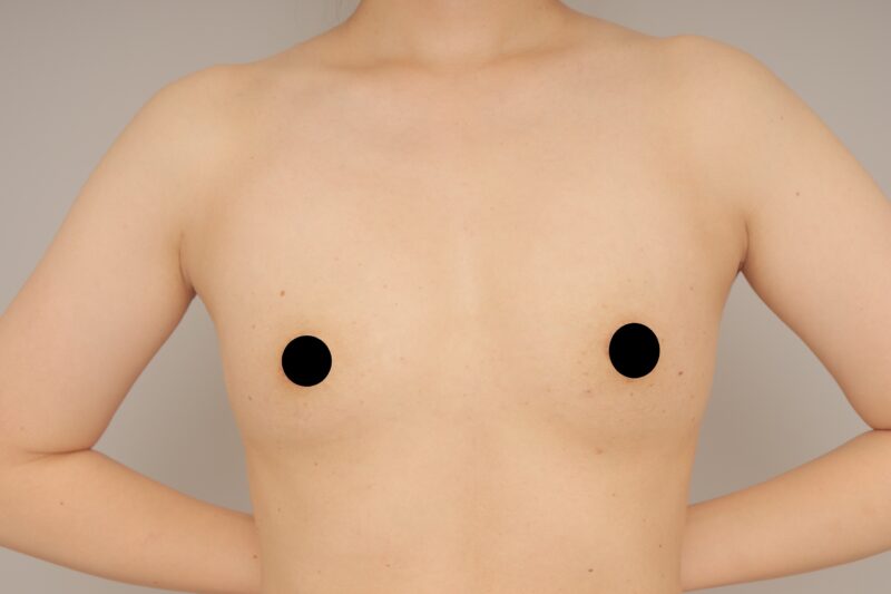 コンデンスリッチ豊胸3カ月後♪　モニター様の3か月経過をご紹介♪　34歳 167cm 54kg