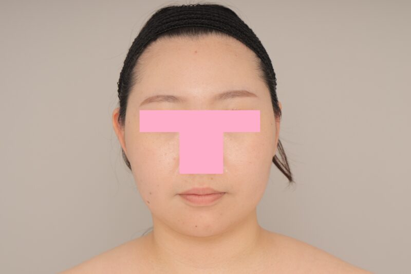 ベイザー脂肪吸引（6か月経過：28）の術後写真