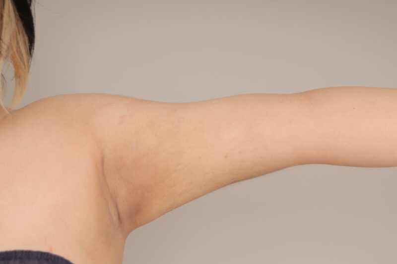 ベイザー脂肪吸引（6か月経過：26）の術後写真