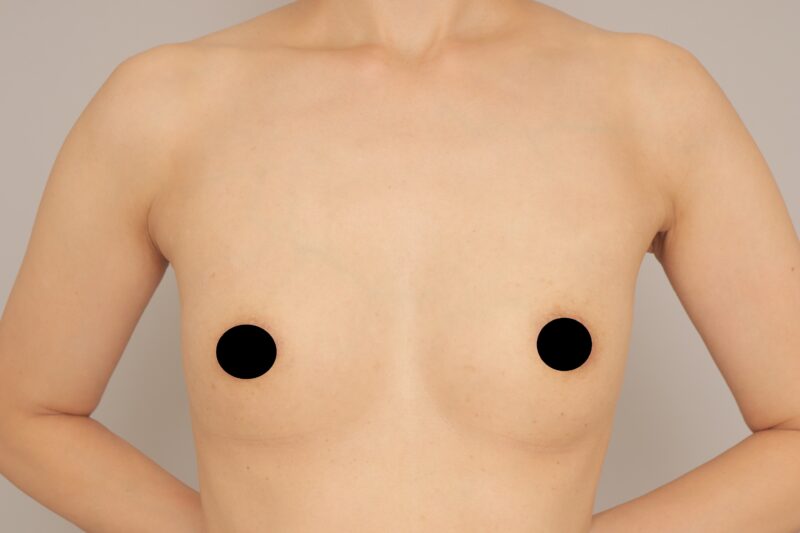 コンデンスリッチ豊胸4ヵ月♪　モニター様の1か月経過をご紹介♪　38歳 157cm 43kg