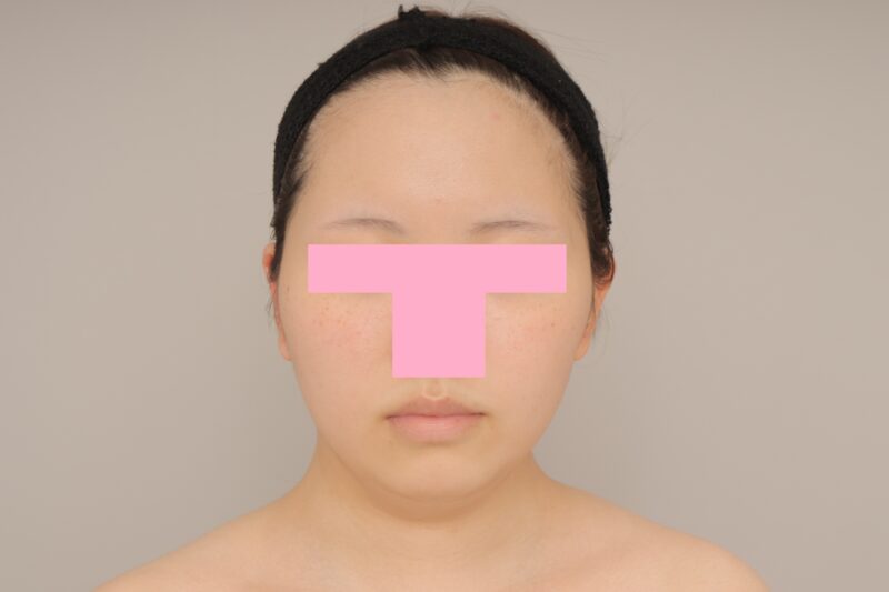 ベイザー脂肪吸引（3か月経過：19）の術後写真