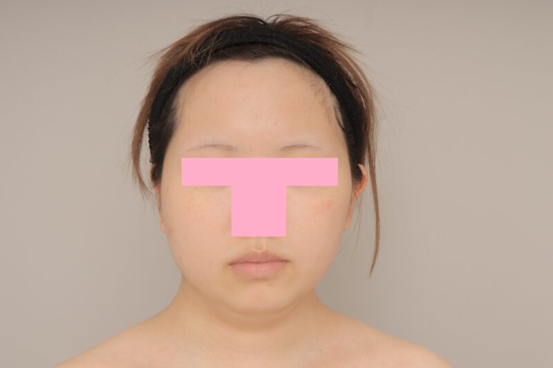 ベイザー脂肪吸引（3か月経過：19）の術前写真