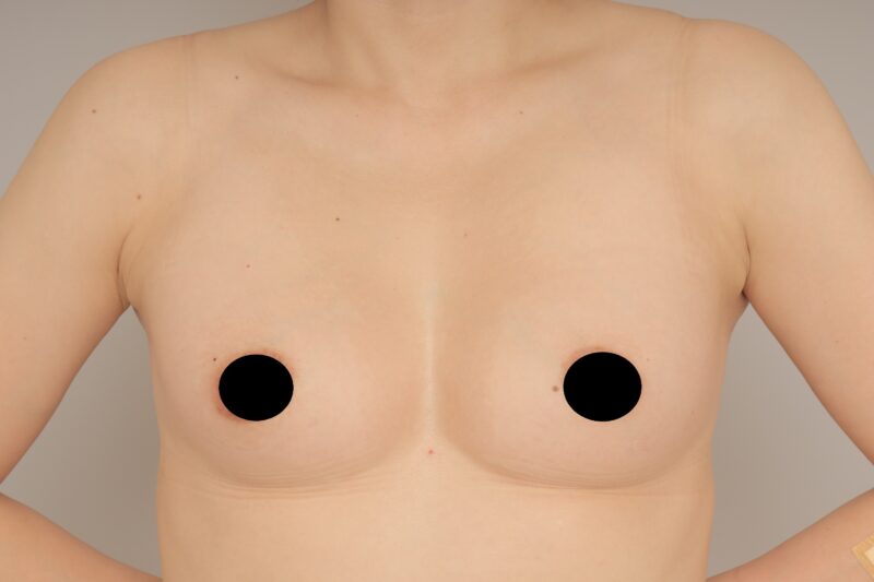 ベイザー脂肪吸引(3か月経過:44)の術後写真