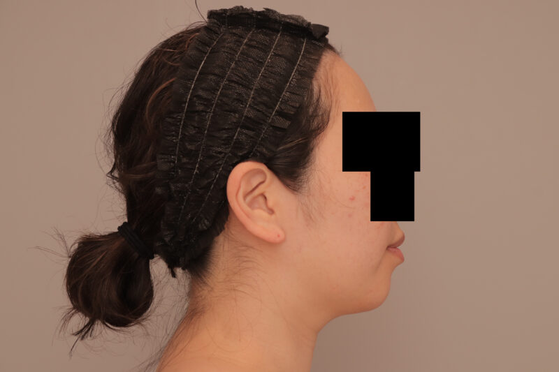 ベイザー脂肪吸引（半年後経過：36）の術前写真