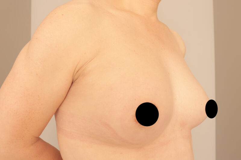 ベイザー脂肪吸引(半年後経過:58)の術後写真