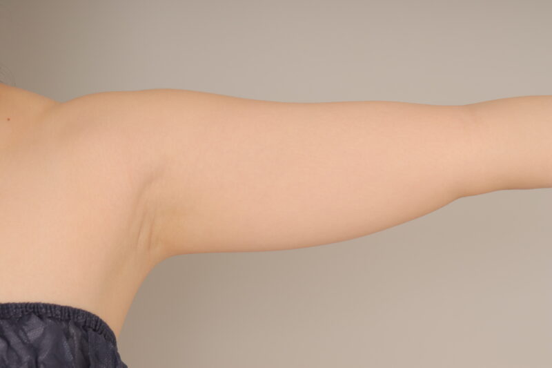 ベイザー脂肪吸引（3か月経過：35）の術前写真