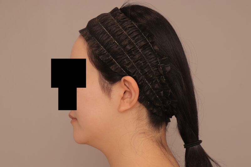 ベイザー脂肪吸引(半年後経過:24)の術前写真