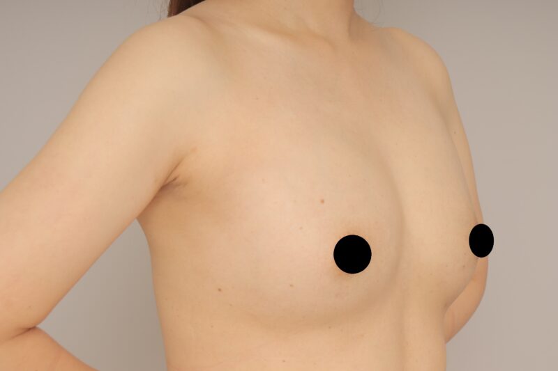 2回目コンデンスリッチ豊胸で美しく！　モニター様の1か月経過をご紹介♪　34歳 167cm 54kg