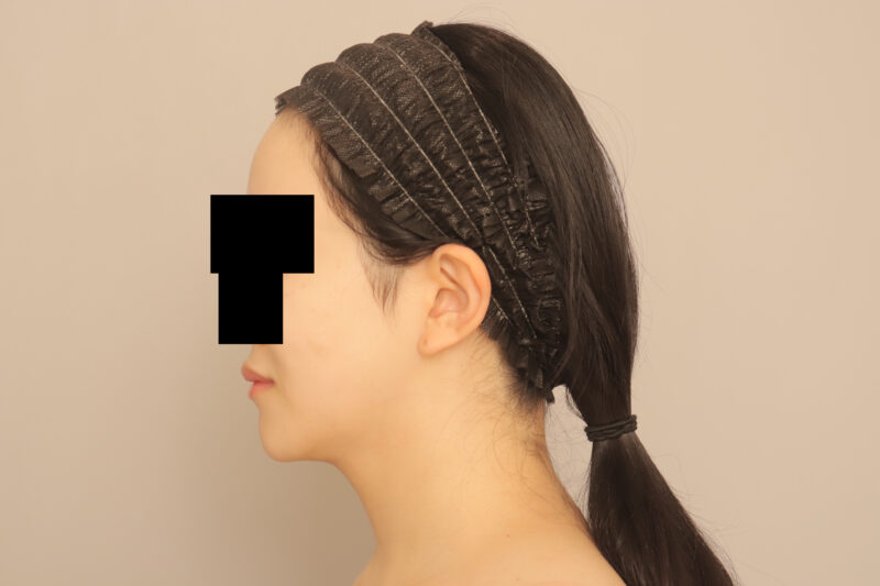 ベイザー脂肪吸引(半年後経過:24)の術後写真