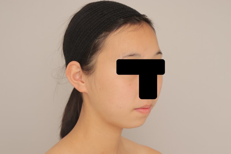 ベイザー脂肪吸引(1ヶ月経過:17)の術前写真