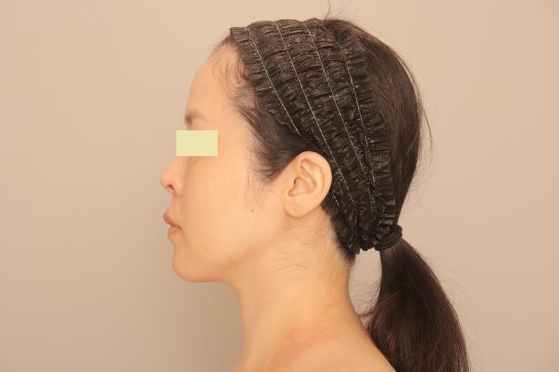 ★お顔の施術６ヶ月後