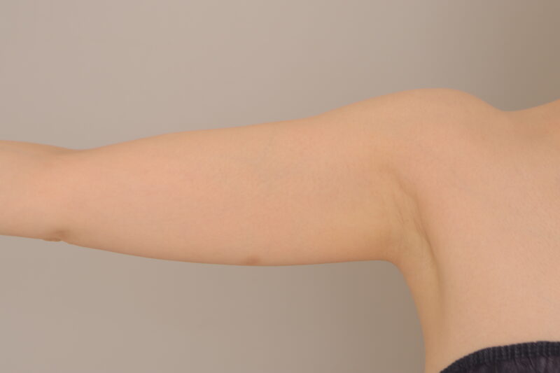 ベイザー脂肪吸引（半年経過：40）の術前写真