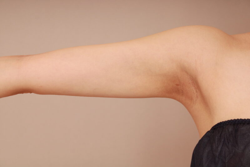 お一人お一人に合わせたオーダーメイドの脂肪吸引を致します！