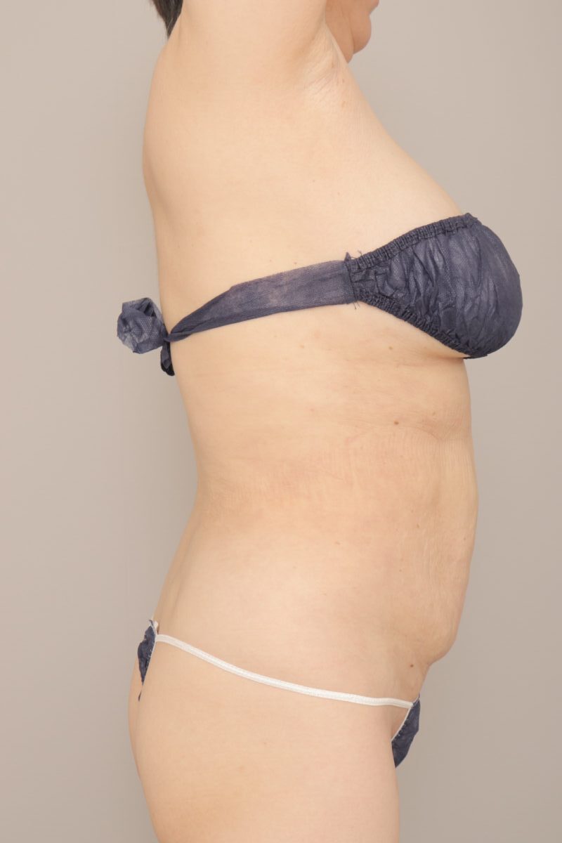 57歳女性、お腹と腰で3000ccを吸引した方の１か月経過です。