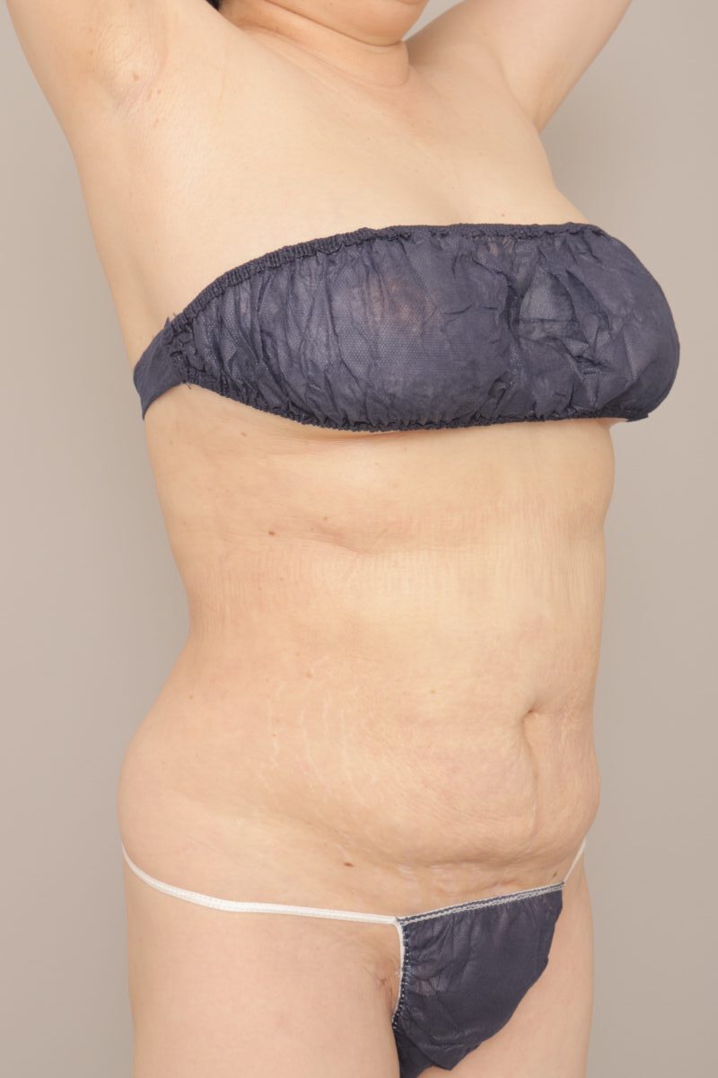 ベイザー脂肪吸引（１ヶ月経過：57）の術後写真