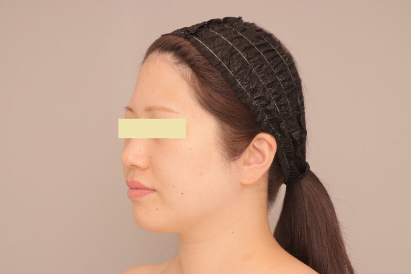 ベイザー脂肪吸引(3ヶ月経過:35)の術前写真