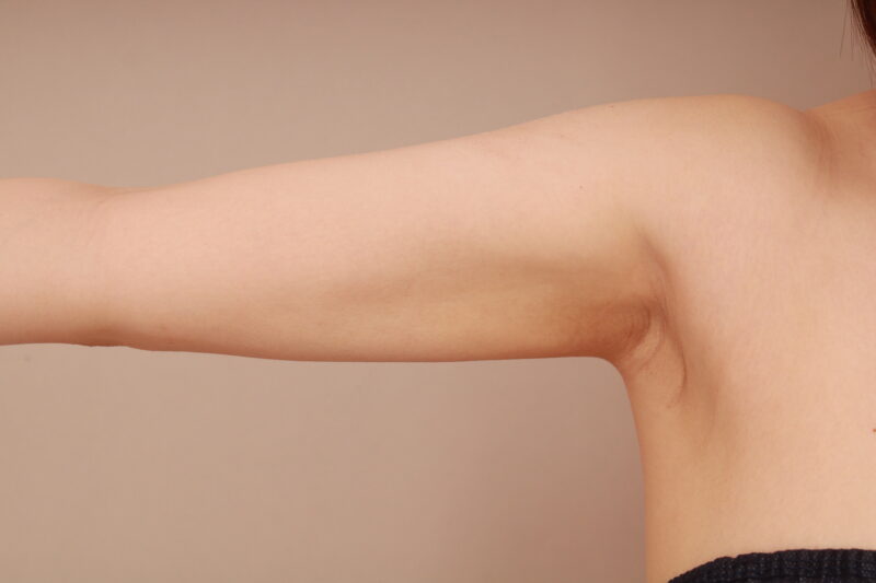 腕の吸引で半端丈やノースリーブも似合う二の腕美人に！