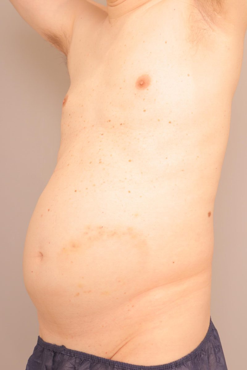 ベイザー脂肪吸引（3ヶ月経過：53）の術前写真