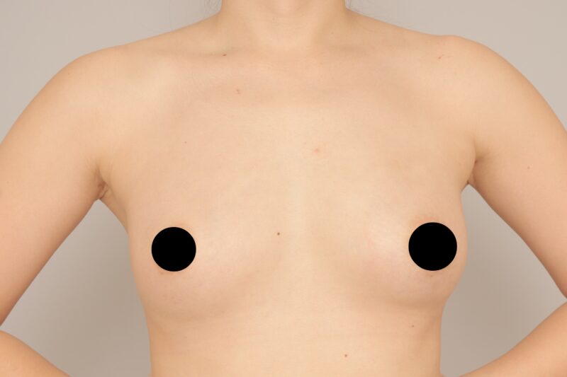 ベイザー脂肪吸引（１ヶ月経過：38）の術後写真