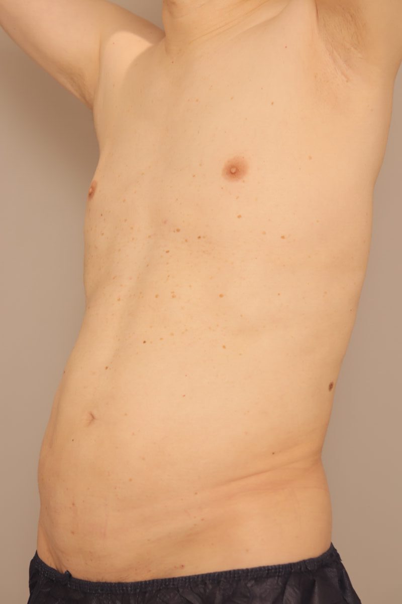 ベイザー脂肪吸引（3ヶ月経過：53）の術後写真