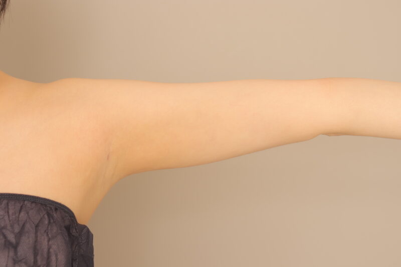二の腕・肩の脂肪吸引 術後6ヶ月の経過