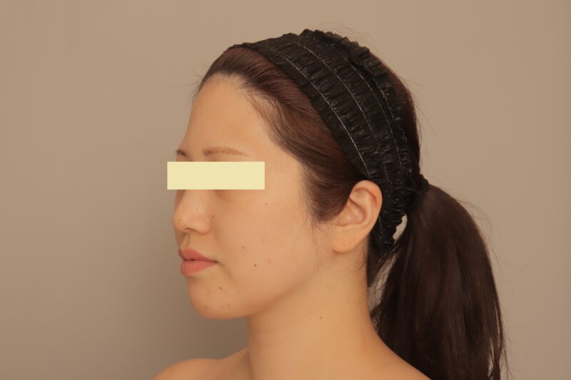 ベイザー脂肪吸引(3ヶ月経過:35)の術後写真