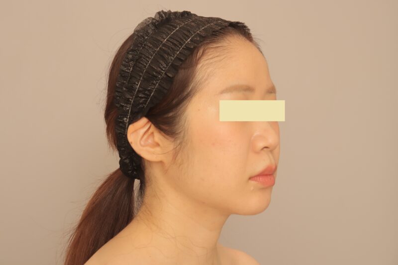 ベイザー脂肪吸引（半年経過：35）の術後写真