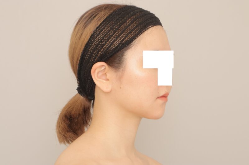 ベイザー脂肪吸引(半年経過:24)の術後写真