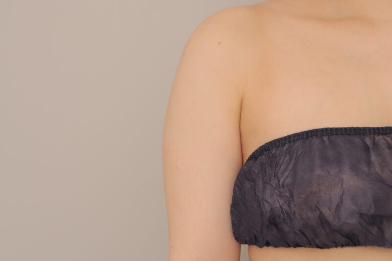 ベイザー脂肪吸引（3ヶ月経過：25）の術後写真