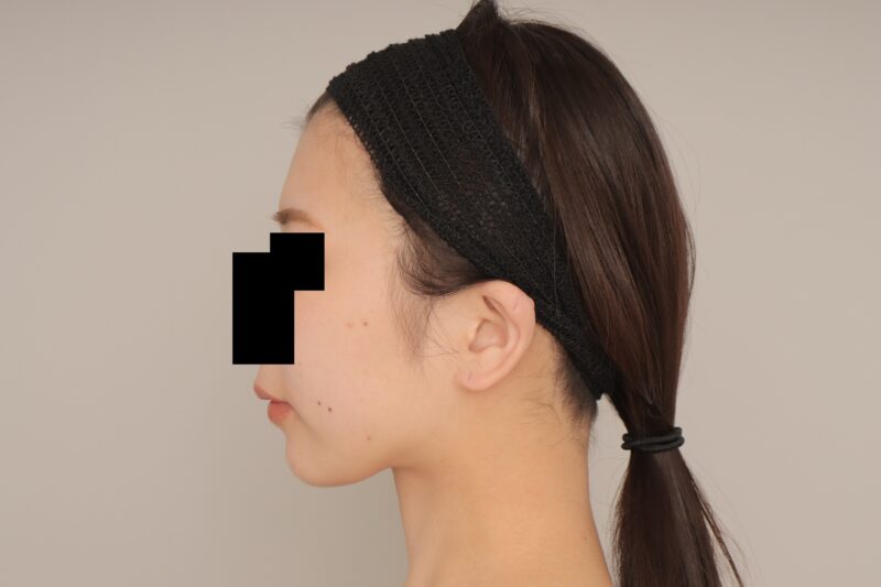 20代女性、お顔の脂肪吸引は3ヶ月でこれほど綺麗になります