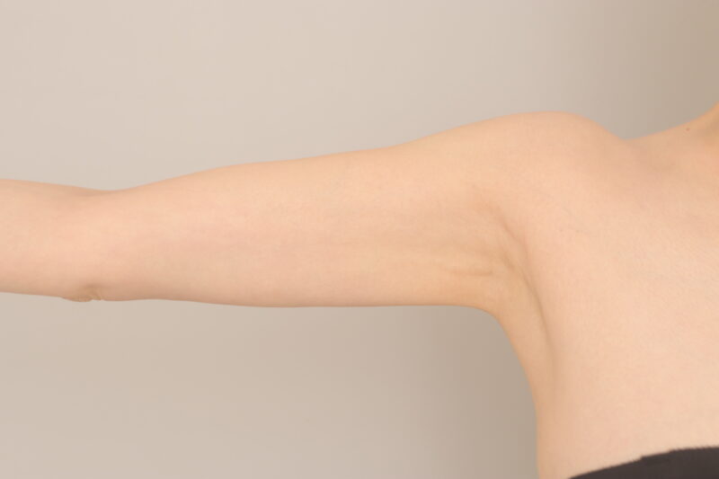 ベイザー脂肪吸引（半年経過：40）の術後写真