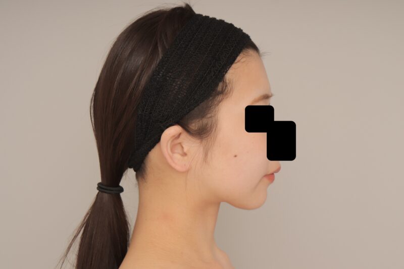 20代女性の頬顎下脂肪吸引、3か月経過です