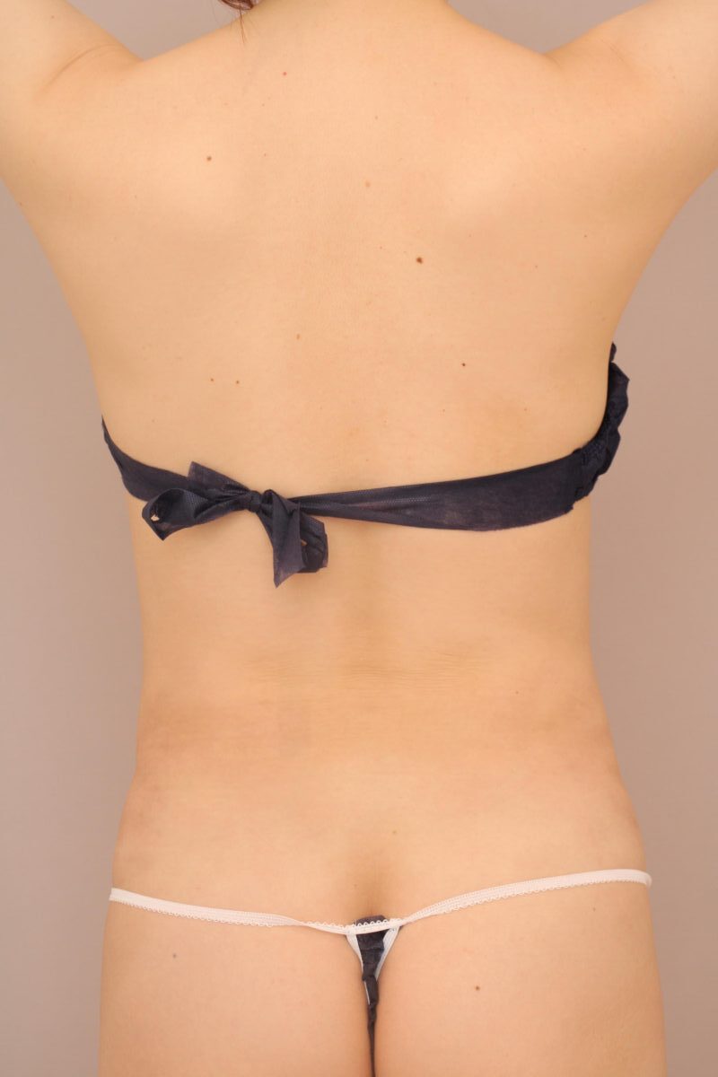 腰と腹部の吸引で多方向からアプローチ、より理想のシルエットのくびれに！