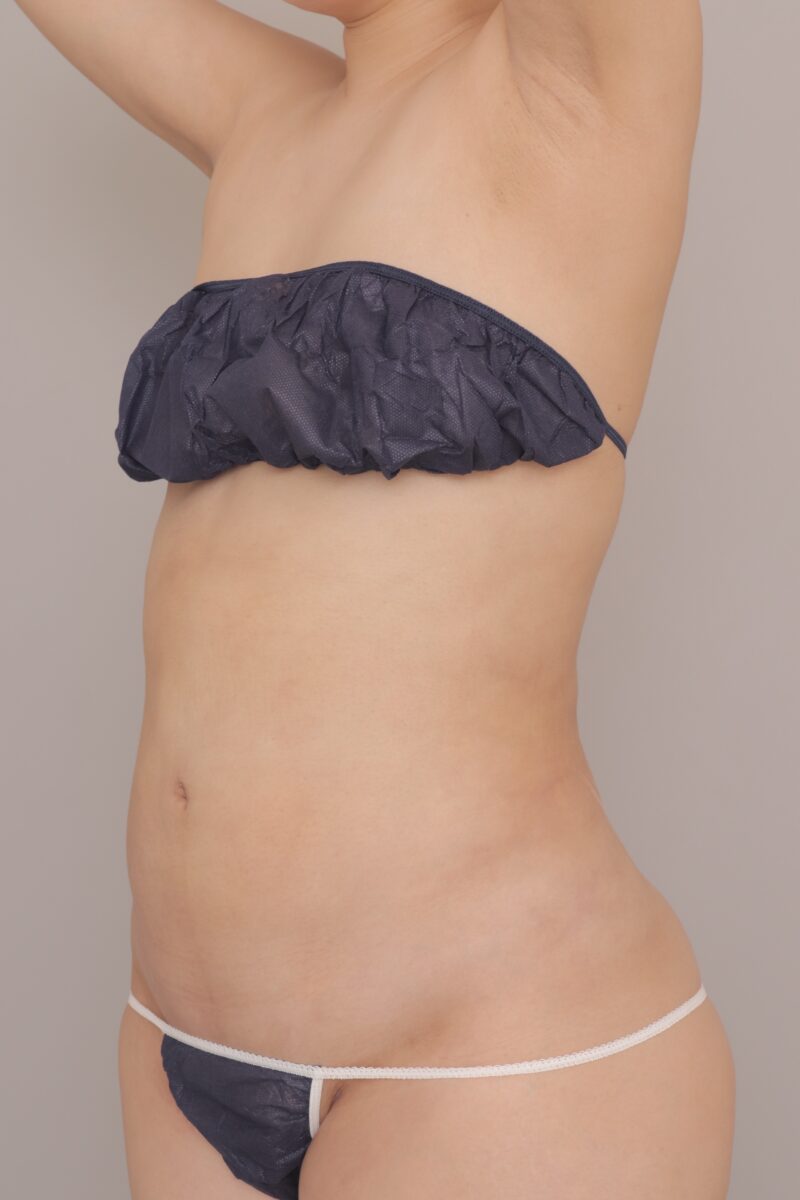 1ヶ月でここまで変わる！2900cc吸引で“ぽっこりお腹”がスッキリ薄いウエストに