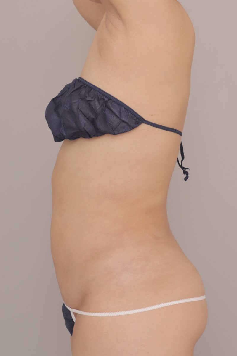 ベイザー脂肪吸引（1ヶ月経過：29）の術後写真