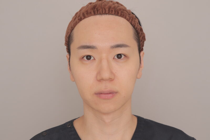 僕自身の頬顎下脂肪吸引経過