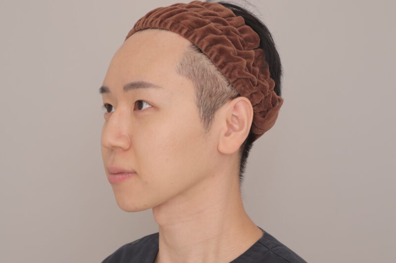 ベイザー脂肪吸引（6ヶ月経過：31）の術後写真