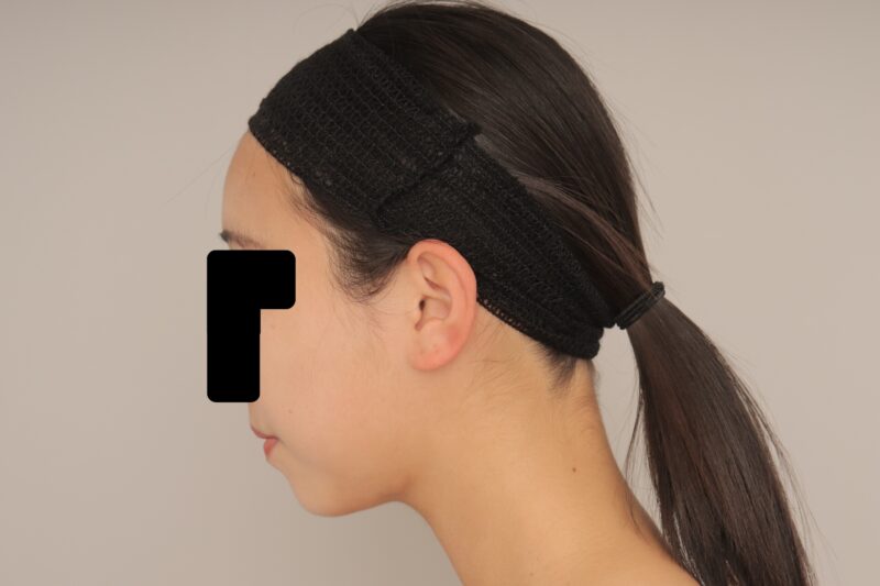 顎下の脂肪吸引、1か月経過のご紹介です。