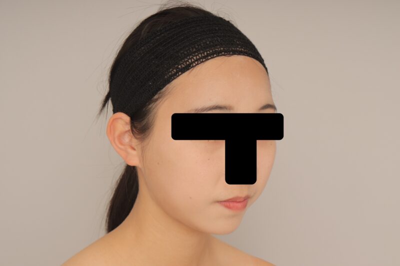 ベイザー脂肪吸引(1ヶ月経過:17)の術後写真