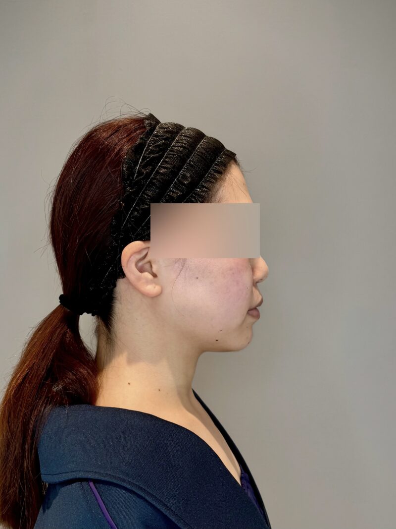 ベイザー脂肪吸引(術後3ヶ月経過:28)の術前写真