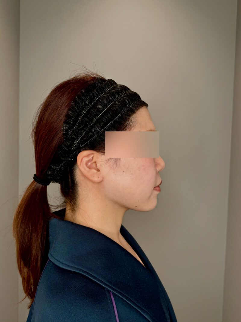 ベイザー脂肪吸引(術後3ヶ月経過:28)の術後写真