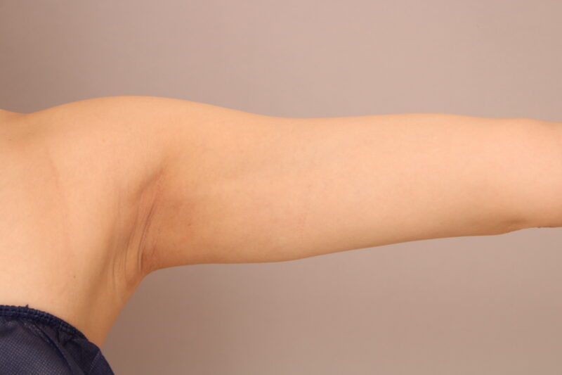 オーダーメイドの脂肪吸引で理想のラインの華奢腕に！