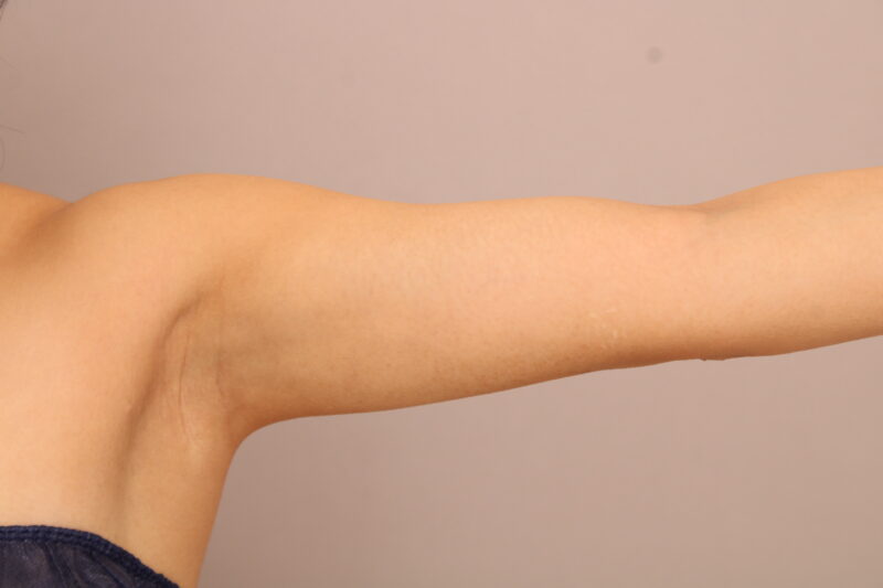 振袖や腕のボリュームが気になる方はぜひ一度ご相談ください！