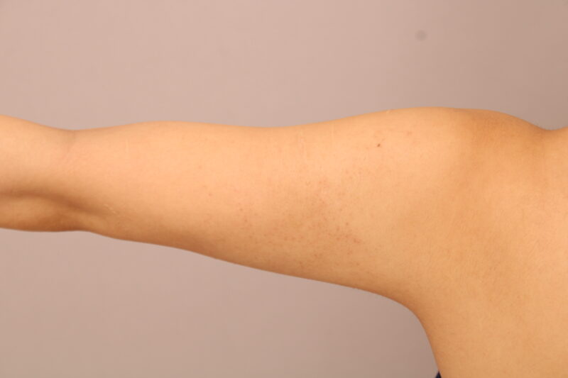 ベイザー脂肪吸引(2か月半経過:24)の術後写真