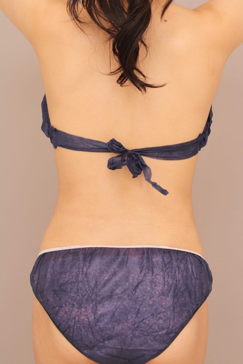 腰と腹部の双方向からの脂肪吸引で、より理想のくびれに近づけられます！