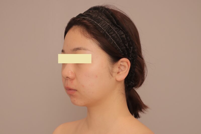 ベイザー脂肪吸引(半年経過:27)の術前写真