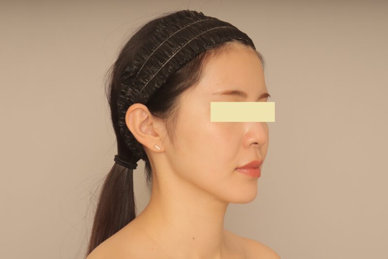 ベイザー脂肪吸引(半年経過:32)の術後写真