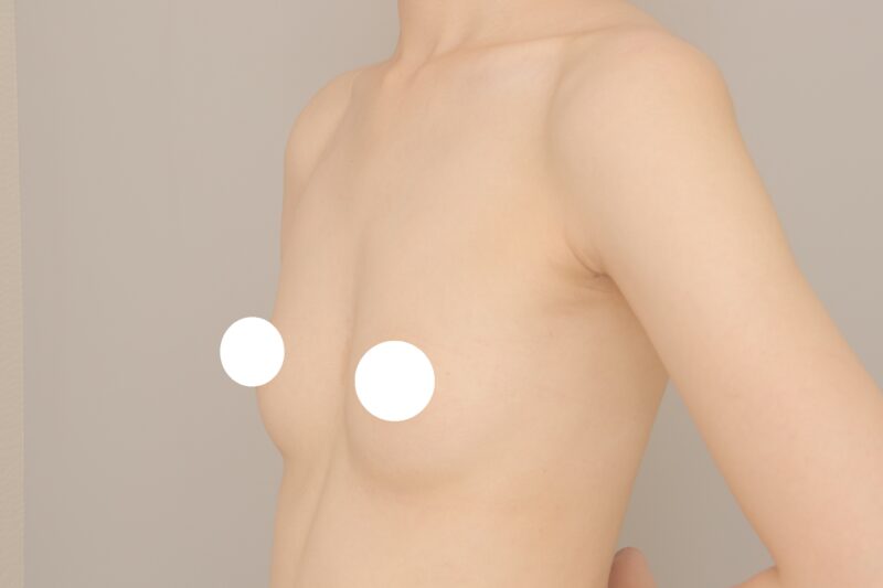 ベイザー脂肪吸引(3ヶ月経過:25)の術前写真